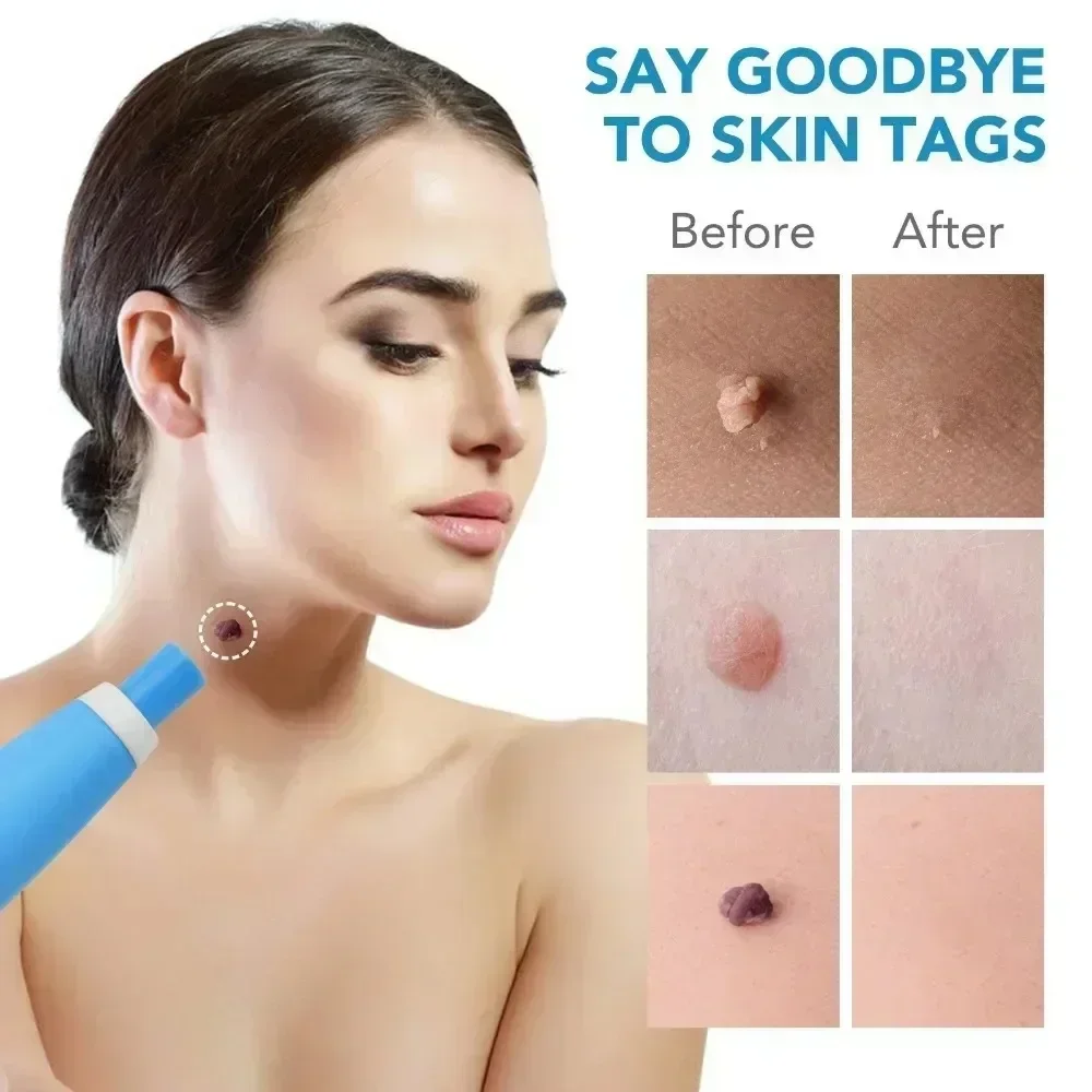 2 IN 1 Painless Auto Micro Skin Tag Removal Kit Adult Skin Tag Mole Wart Remover Device Face Cleaning Skin Care Beauty Tools photo 4